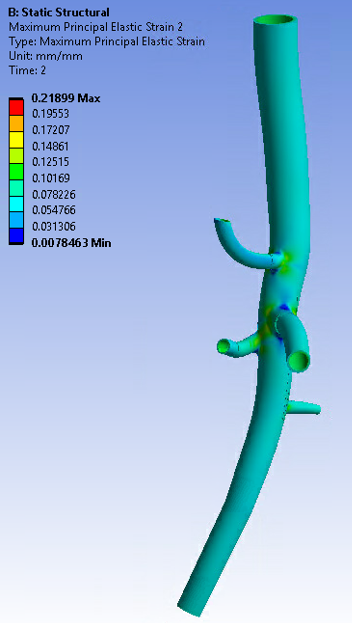 Maximum Principal Strain Plot of the Abdominal Aorta Model at End-Systolic Pressure (120 mm Hg)