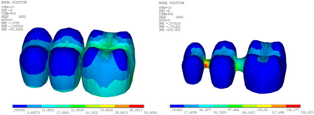 Von Mises Stress in Veneer and Core at 600 Seconds