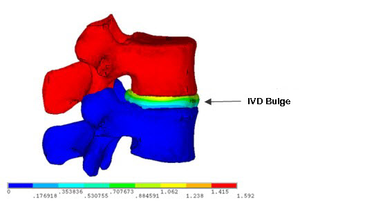 IVD Deformation