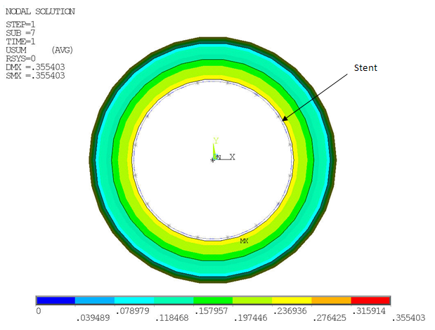 Cross-Sectional View of Artery and Stent After Balloon Angioplasty (Load Step 1)