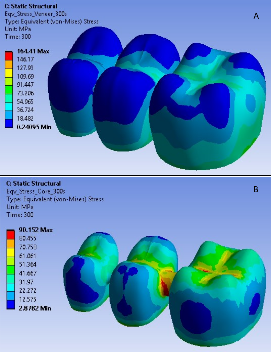 Von Mises Stress in Veneer (A) and Core (B) at 300 Seconds