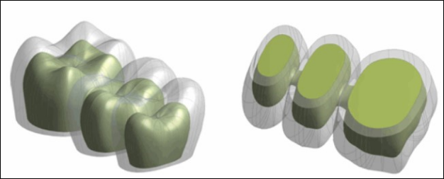 FPD Ceramic Core Geometry (Inside the Veneer)