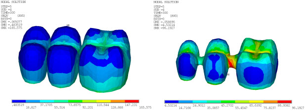 Von Mises Stress in Veneer and Core at 300 Seconds