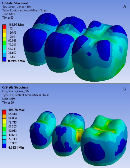 Von Mises Stress in Veneer (A) and Core (B) at 60 Seconds