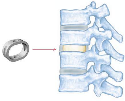Spinal Spacer Implant