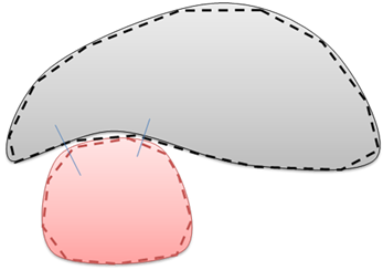 Two Contact Points