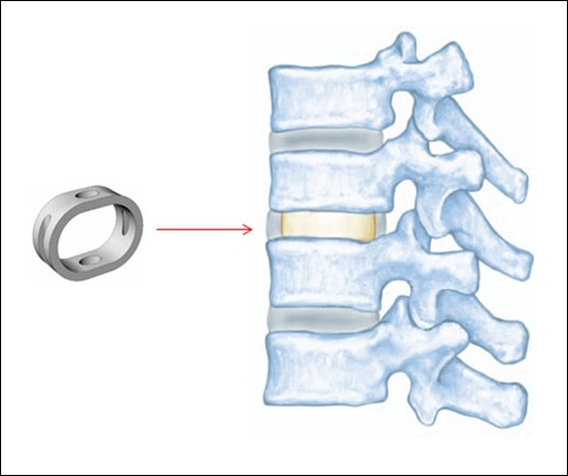 Spinal Spacer Implant